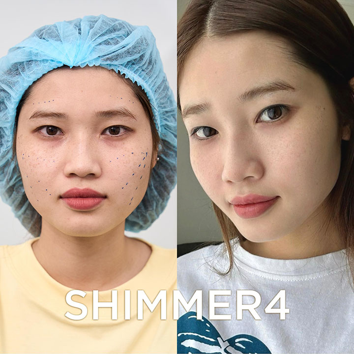 Shimmer4 - Bí kíp giữ mãi tuổi xuân của nhiều chị em