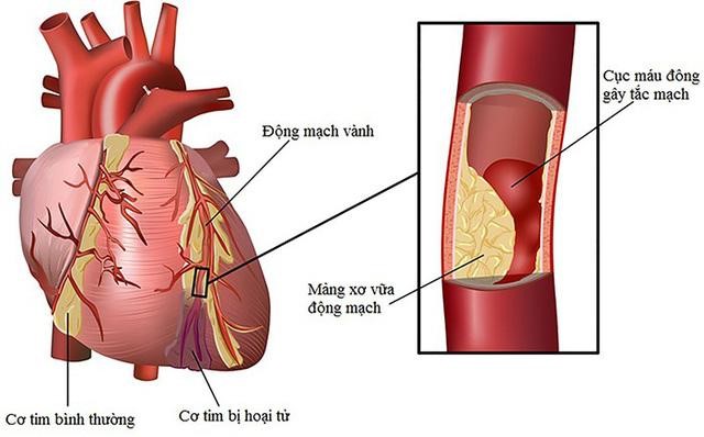 Nhồi máu cơ tim do biến chứng máu nhiễm mỡ